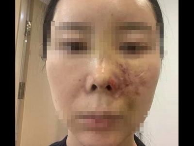 女子在沈陽美萊整形后面部青紫不敢見人 賠償問題未能達成一致